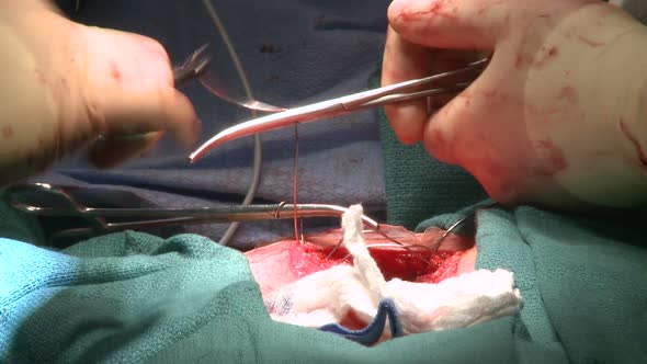 Surgeon Using Wire To Stitch Ribcage After Surgery (1 Of 2)