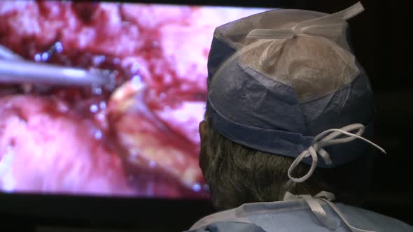 Surgeons At Work During Laparoscopic Appendectomy (3 Of 6)