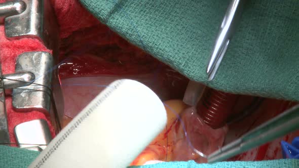 Surgeons Perform Open Heart Surgery (2 Of 4)