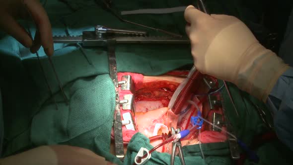 Surgeons Perform Open Heart Surgery (4 Of 4)