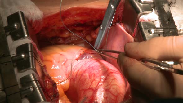 Doctors Perform Surgery On Beating Heart (2 Of 3)