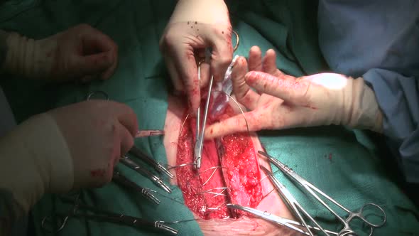 Suturing Chest Incision (2 Of 5)