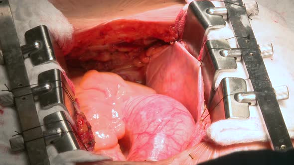 Heart Beats Through Open Chest During Surgery (7 Of 9)