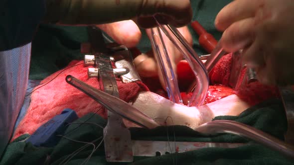Tubes Being Positioned During Open Heart Surgery (1 Of 4)