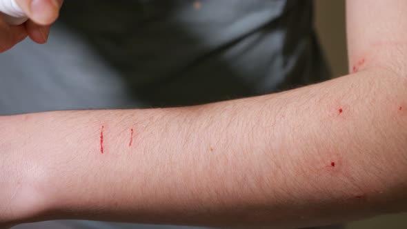 Woman Handles Scratches and Bites on Her Arm alt