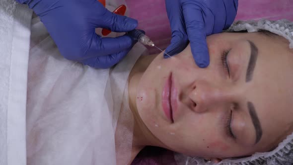 A Beautician Makes Injections of Hyaluronic Acid with a Medical Syringe