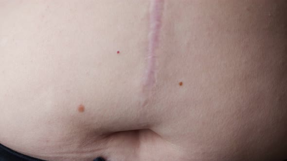 Long After Surgery Scar on Female Abdomen Above Navel alt
