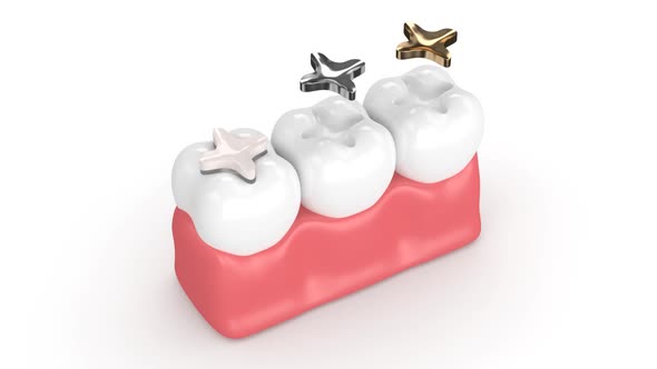 Teeth with different types of dental inlay filling