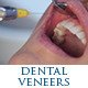 Grinding Dental Veneers Pack - VideoHive Item for Sale