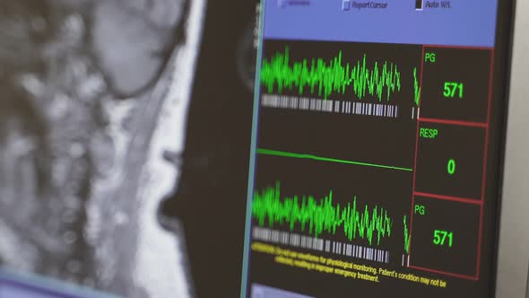 Tomograph in Action the Computer Screen Displays the Head Scan in the Magnetic Resonance Imaging alt