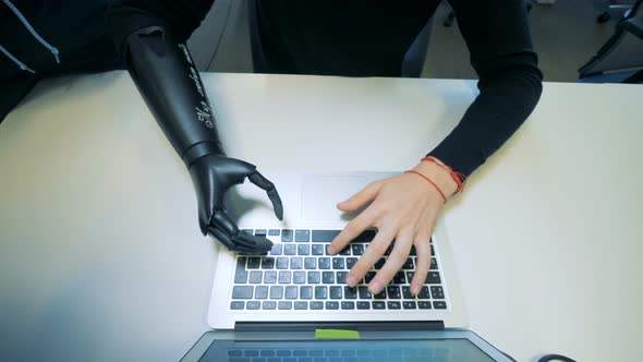 Man with Artificial Hand Types on a Laptop. Cyborg Concept alt