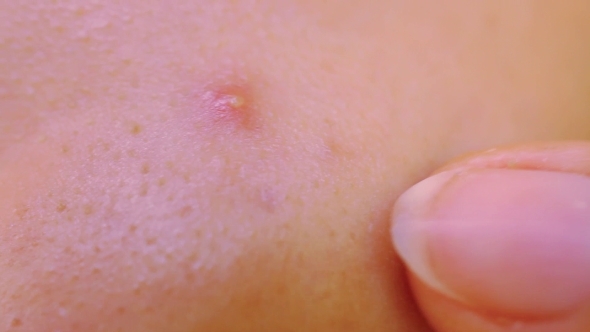Pimple On The Skin 