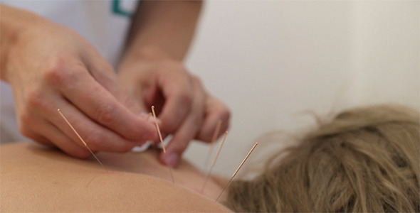 Treatment by Acupuncture