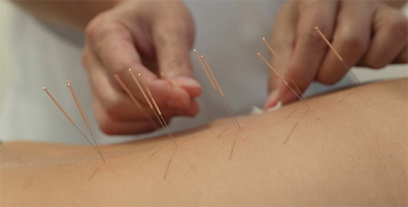 Treatment by Acupuncture