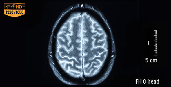 Brain MRI Scan