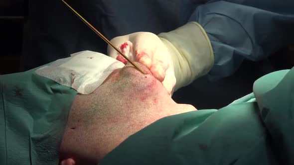 Face and Neck Liposuction for Man 5