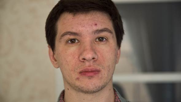 Man With Acne Man With Acne