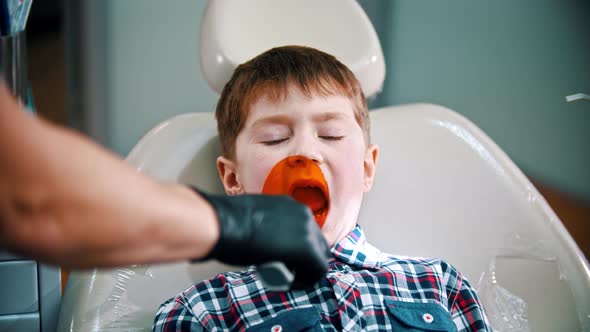 A Little Boy Having His Tooth Done - Putting the Photopolymer Lamp in the Mouth alt