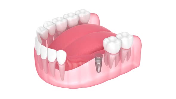 Jaw with smart implant detector helping to locate buried healing cap over white background