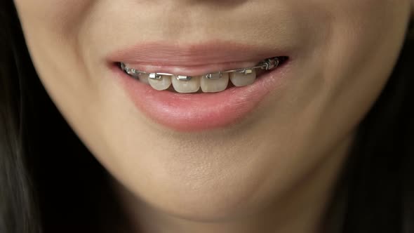 Beautiful Macro Shot of White Teeth with Braces alt