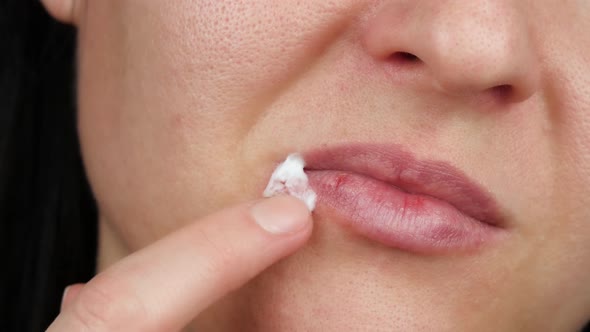 Female Face Close-up with Herpesvirus Disease. A Woman Puts Medicine, Cream on Herpes Inflammation alt