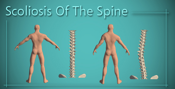 Scoliosis Of The Spine alt