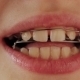 Smile With Braces on Teeth - VideoHive Item for Sale