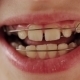 Dental Plate In The Teeth Of The Child - VideoHive Item for Sale