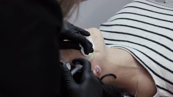 Cosmetologist doctor is making multiple injections biorevitalization with hyaluronic acid in face alt