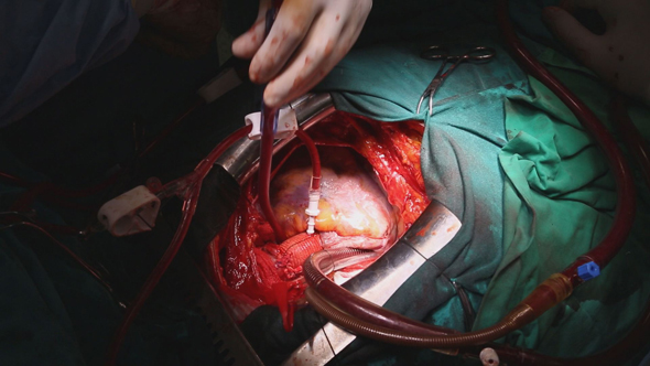 Beating Heart During Heart Surgery alt