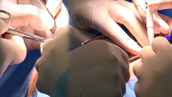 Blepharoplasty or Eyelid Surgery 4 alt