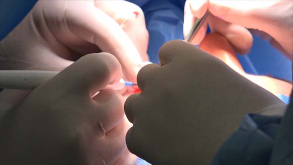 Blepharoplasty or Eyelid Surgery 10 alt