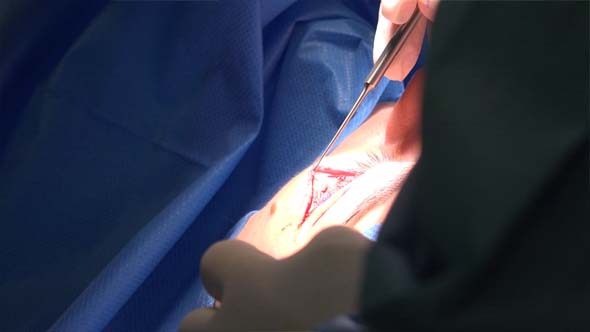 Blepharoplasty or Eyelid Surgery 12 alt