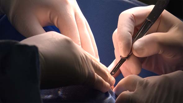 Blepharoplasty or Eyelid Surgery 17 alt