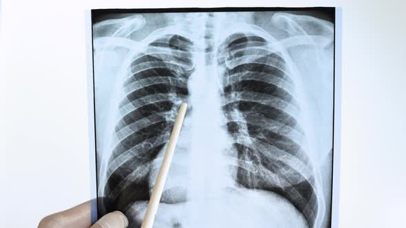 Radiologist   A Specialist Analyzes An X Ray Of A Person's Lungs On A White Background.
