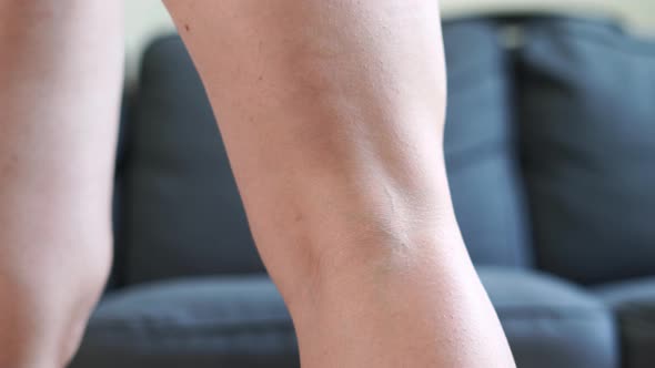 Woman's Leg with Varicose Veins. Treatment with Cream.  alt
