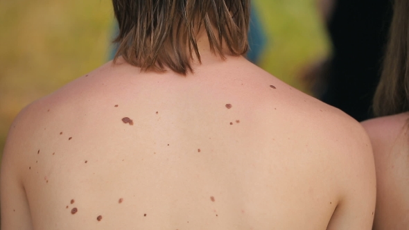 Moles On The Body alt