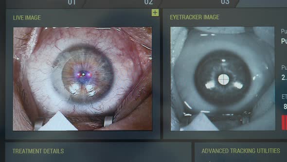 Computer Display with Eye Images During Laser Correction alt