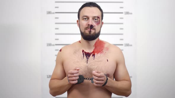 In Police Station Arrested Man with Wounded Face Getting Front-view Mug Shot alt