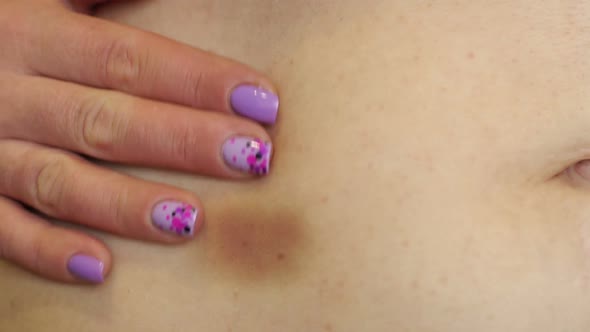Close-up of a Large Bruise or Bruise on the Skin of the Abdomen of a Woman. alt