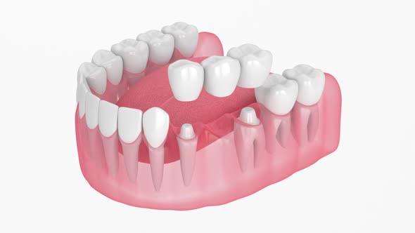 Jaw with traditional dental bridge over white background