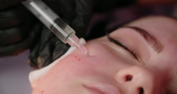 Beautician Does Injections to the Woman's Face Botox and Hyaluronic Acid Rejuvenating Beauty