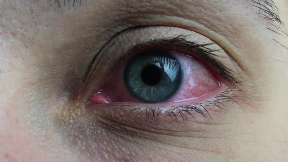 Sore Red Human Eye alt