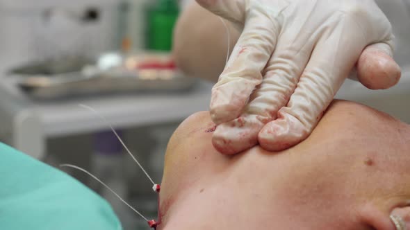 The Surgeon Cuts the Threads After Plastic Surgery on the Patient's Face