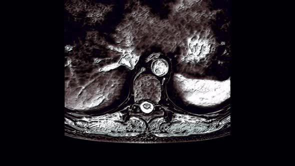 MRI of the Thoracic Region, Detection of Protrusions and Hernias on the Spine alt