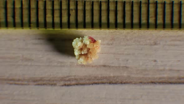 Oxalate Kidney Stone 4 Mm, The Stone Was Removed From The Kidney