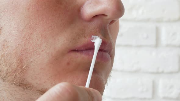Close Up Of A Person's Lip With A Wound Or Pimple. Apply The Herpes Ointment With A Cotton Swab.