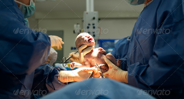 Baby being born via Caesarean Section - Stock Photo - Images