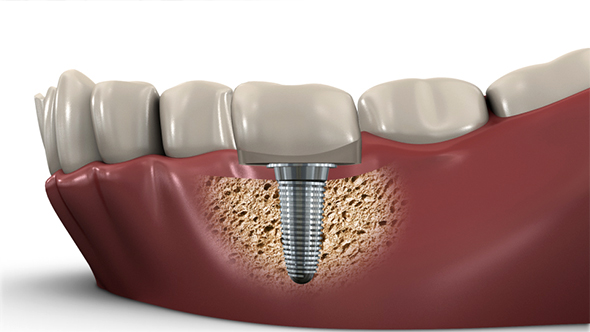 Tooth Human Implant - Dental Concept