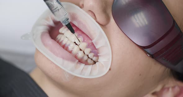 Dentist Stomatologist Application of Protective Whitening Gel to the Teeth alt